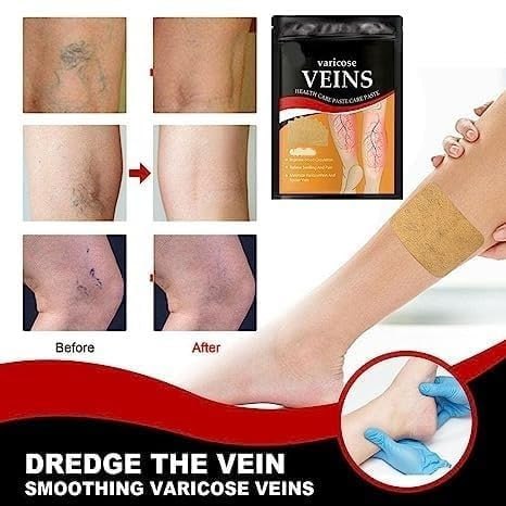 Varicose Veins Patches